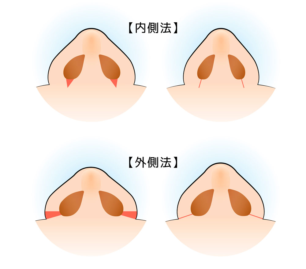 TAC式 鼻翼縮小術（内側法・外側法）