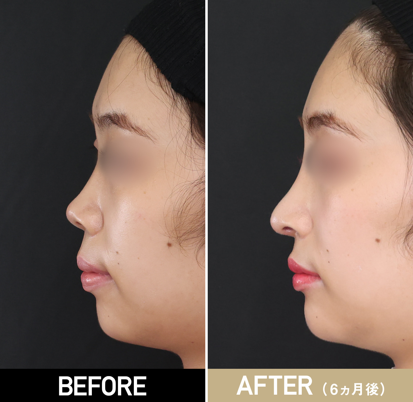鼻整形（鼻中隔延長＋耳軟骨移植＋鼻尖形成＋Cカール形成）|症例写真（施術前・術後6カ月）|20代女性