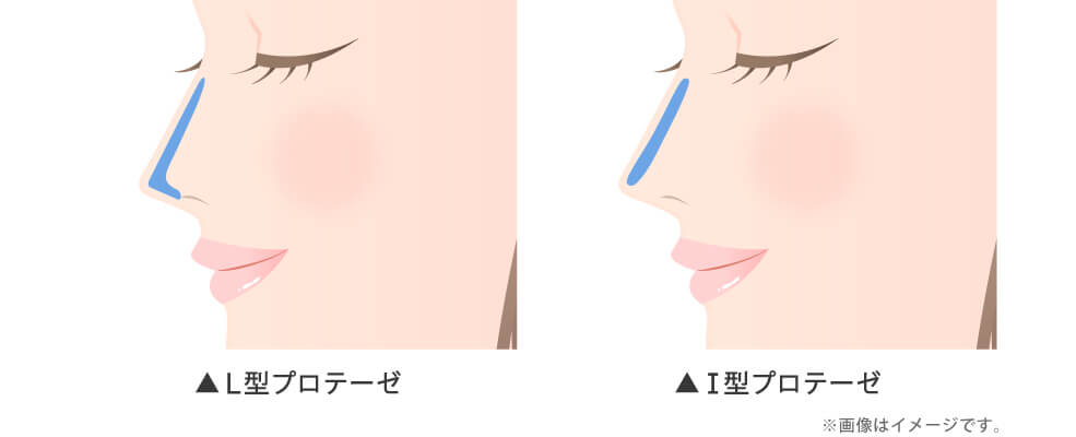 プロテーゼは「L型」「I型」の2種類をベースに理想的な鼻筋を形成