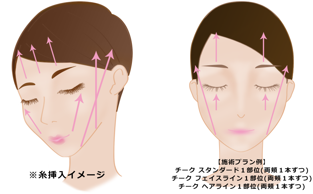 ツヤ肌コラーゲンリフトの施術可能部位について