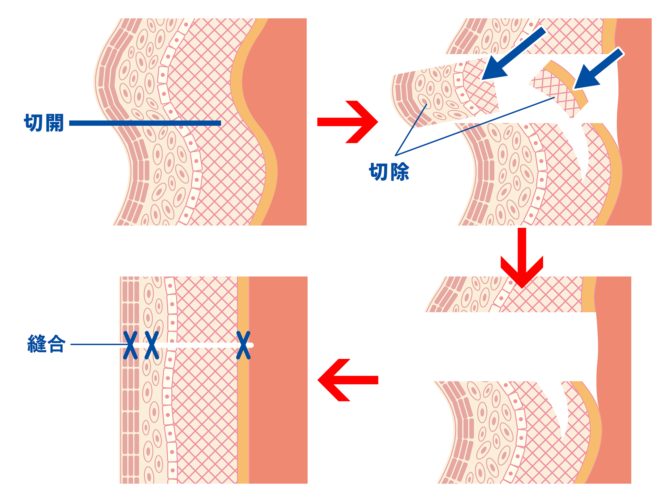 シワやたるみの原因は表情筋(SMAS)SMAS(表在筋膜)の緩み