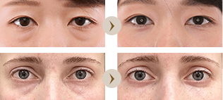 下眼瞼脱脂術（クマ・ふくらみとり）