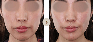 TAC式 ツヤ肌コラーゲンリフト®