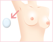 人工乳腺除去術