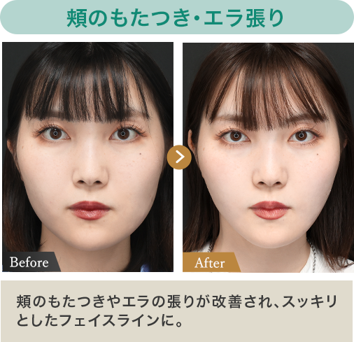 ベース型✕エラ・頬の脂肪｜エラの張りが改善され、さらに口周りがスッキリしたことで下顔面の印象が変わりました。