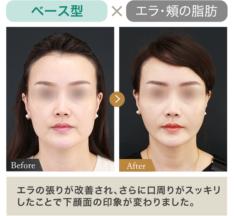 ベース型 × エラ・頬の脂肪 エラの張りが改善され、さらに口周りがスッキリしたことで下顔面の印象が変わりました