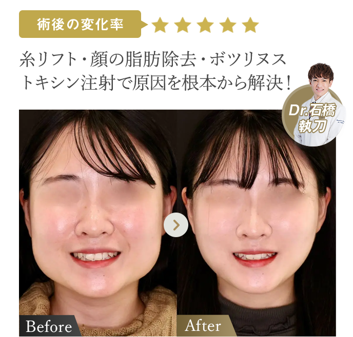 術後の変化率★★★★★ | 糸リフト・顔の脂肪除去・ボツリヌストキシン注射で原因を根本から解決!(Dr石橋執刀) | 症例写真
