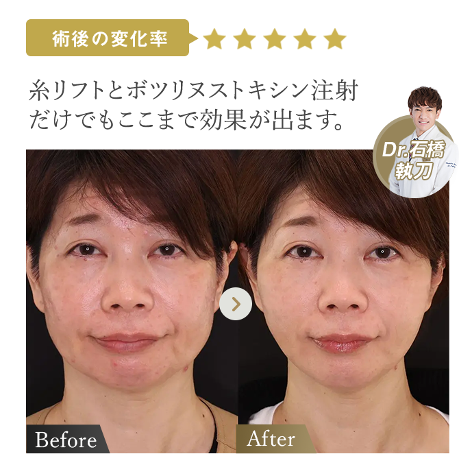 術後の変化率★★★★★ | 糸リフトとボツリヌストキシン注射だけでもここまで効果が出ます。(Dr石橋執刀) | 症例写真