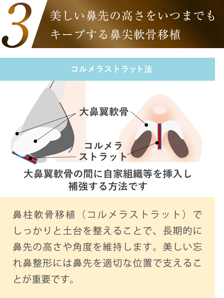 美しい鼻先の高さをいつまでもキープする鼻尖軟骨移植