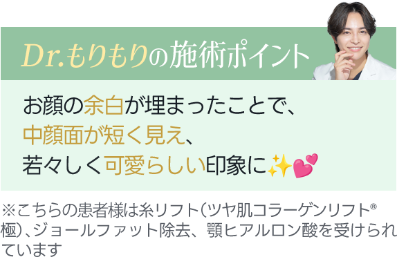 Dr.もりもりの施術ポイント｜お顔の余白が埋まったことで、中顔面が短く見え、若々しく可愛らしい印象に