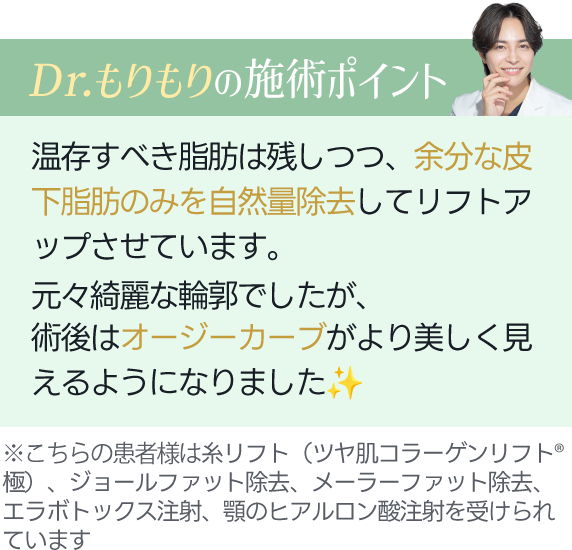 Dr.もりもりの施術ポイント｜温存すべき脂肪は残しつつ、余分な皮下脂肪のみを自然量除去してリフトアップさせています。元々綺麗な輪郭でしたが、術後はオージーカーブがより美しく見えるようになりました。