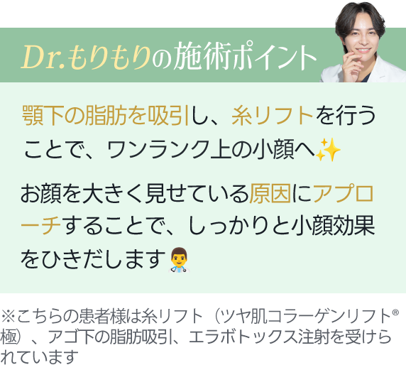 Dr.もりもりの施術ポイント｜顎下の脂肪を吸引し、糸リフトを行うことで、ワンランク上の小顔へ★お顔を大きく見せている原因にアプローチすることで、しっかりと小顔効果をひきだします