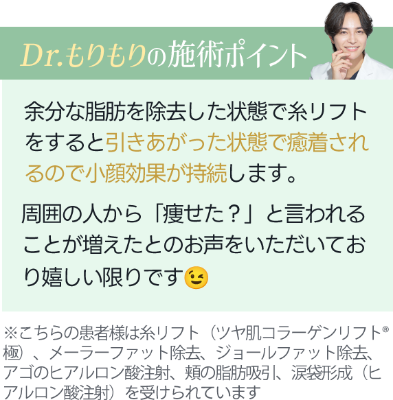 Dr.もりもりの施術ポイント｜余分な脂肪を除去した状態で糸リフトをすると引きあがった状態で癒着されるので小顔効果が持続します。周囲の人から「痩せた？」と言われることが増えたとのお声をいただいており嬉しい限りです