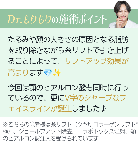 Dr.もりもりの施術ポイント｜たるみや顔の大きさの原因となる脂肪を取り除きながら糸リフトで引き上げることによって、リフトアップ効果が高まります。今回は顎のヒアルロン酸も同時に行っているので、更にV字のシャープなフェイスラインが誕生しました。