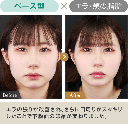 ベース型✕エラ・頬の脂肪｜エラの張りが改善され、さらに口周りがスッキリしたことで下顔面の印象が変わりました。