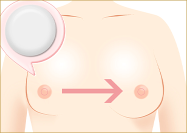 人工乳腺バッグのイメージ