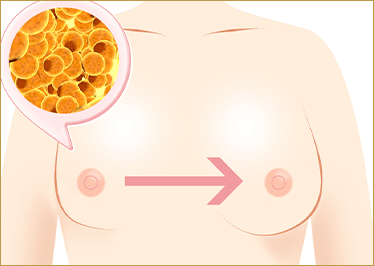 脂肪注入豊胸（ピュアグラフト）のイメージ