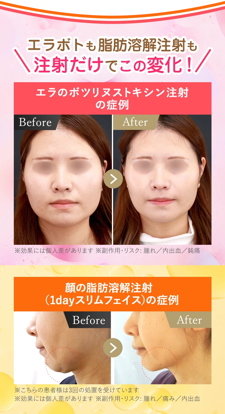 エラボトも脂肪溶解注射も注射だけでこの変化！