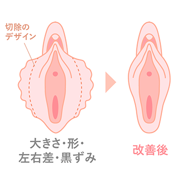 小陰唇縮小術（ヴィーナスシルエット）施術の説明図