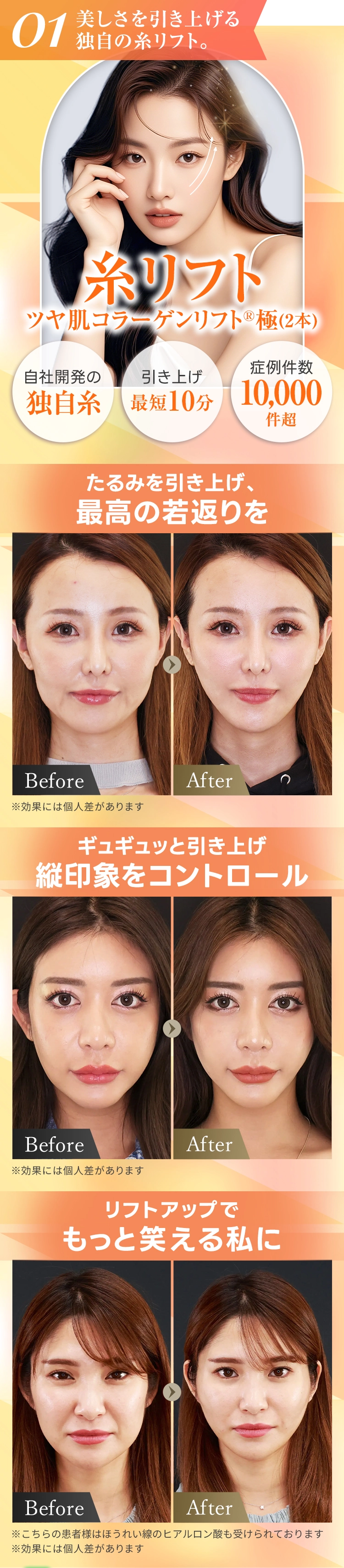糸リフト ツヤ肌コラーゲンリフト®極(2本)