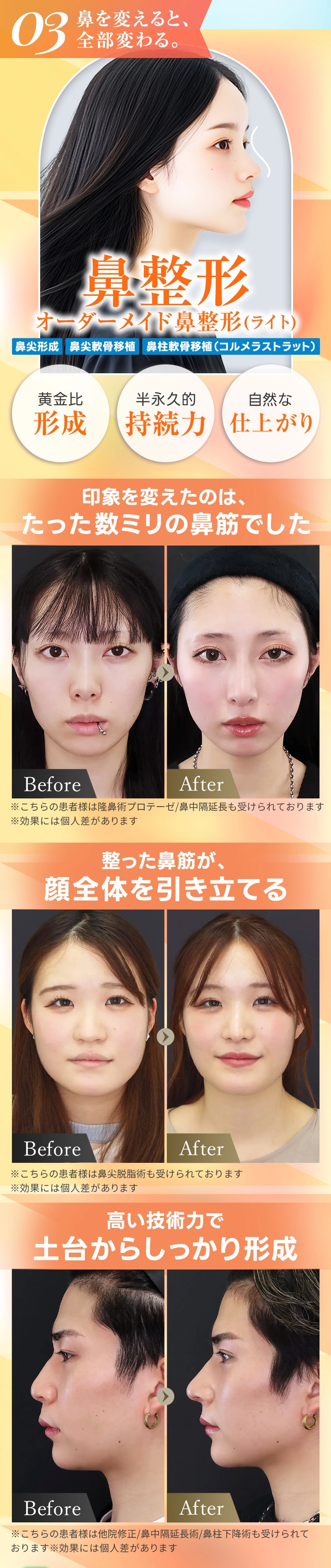 鼻整形 オーダーメイド鼻整形(ライト)