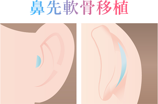 鼻先軟骨移植