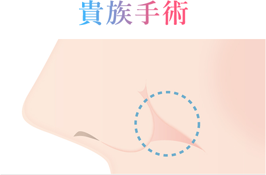 貴族手術