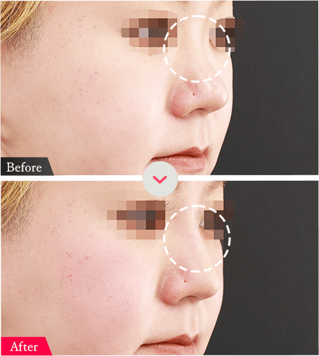 鼻施術の症例ビフォーアフター画像