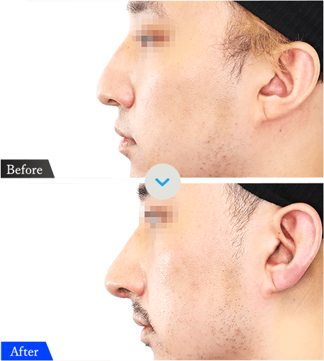 鼻施術の症例ビフォーアフター画像