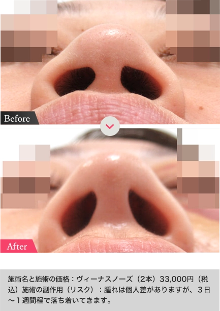 ヴィーナスノーズの症例写真