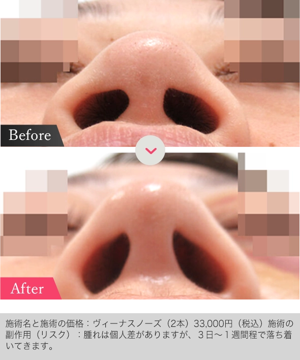 ヴィーナスノーズの症例写真