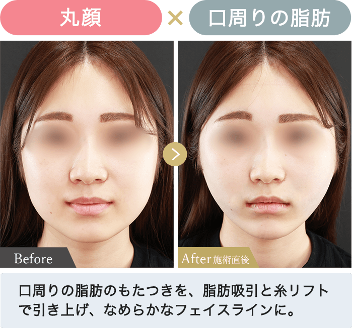 丸顔✕口周りの脂肪｜口周りの脂肪のもたつきを、脂肪吸引と糸リフトで引き上げ、なめらかなフェイスラインに。