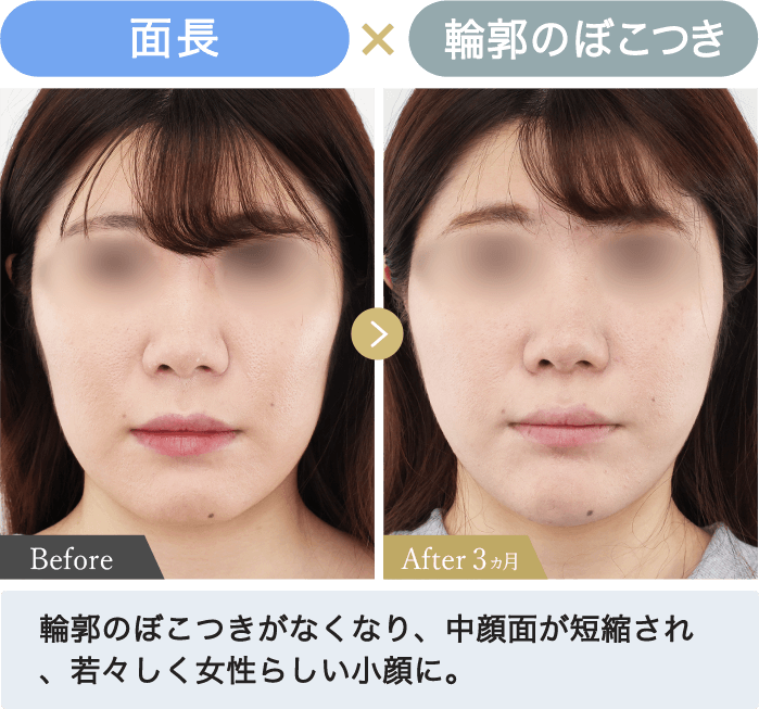面長✕輪郭のぼこつき｜輪郭のぼこつきがなくなり、中顔面が短縮され、若々しく女性らしい小顔に。