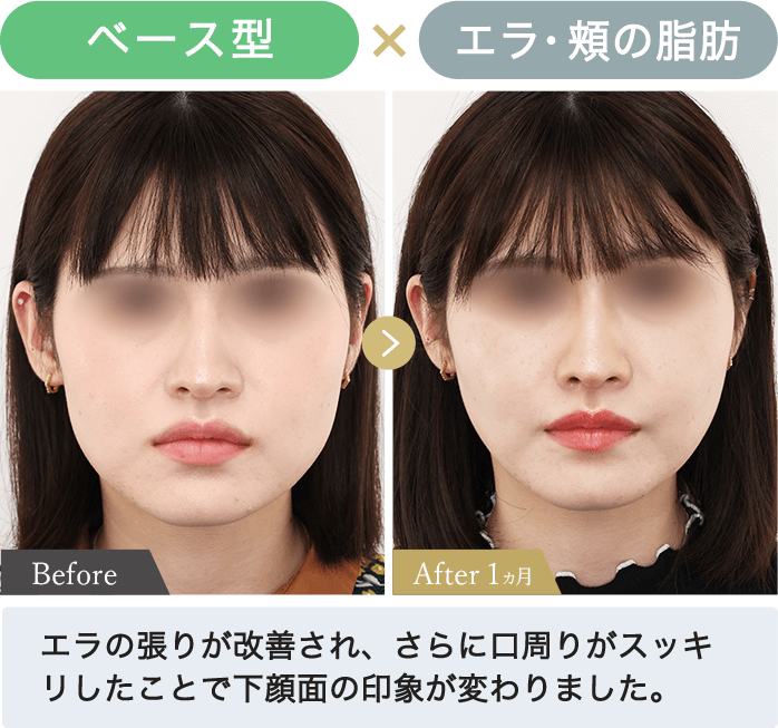 ベース✕エラ・頬の脂肪｜エラの張りが改善され、さらに口周りがスッキリしたことで下顔面の印象が変わりました。