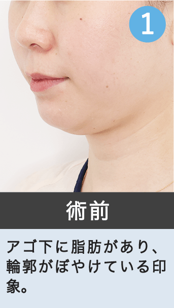 術前｜アゴ下に脂肪があり、輪郭がぼやけている印象。