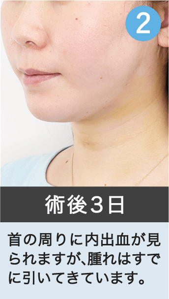 術後３日｜首の周りに内出血が見られますが、腫れはすでに引いてきています。