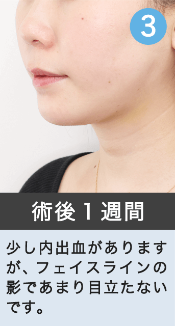 術後１週間｜少し内出血がありますが、フェイスラインの影であまり目立たないです。