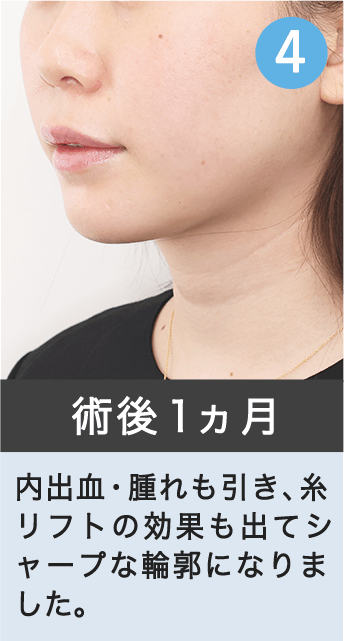 術後１か月｜内出血・腫れも引き、糸リフトの効果も出てシャープな輪郭になりました。