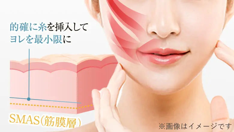 糸を挿入することでしっかりとリフトアップ効果が感じられます。