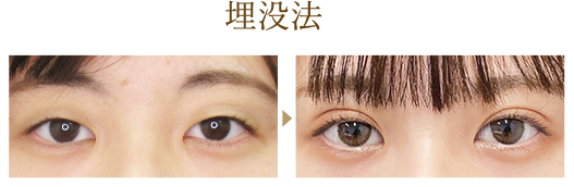 埋没法 1dayナチュラルデザインオプティマル