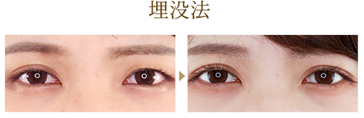 埋没法 1dayナチュラルデザイン