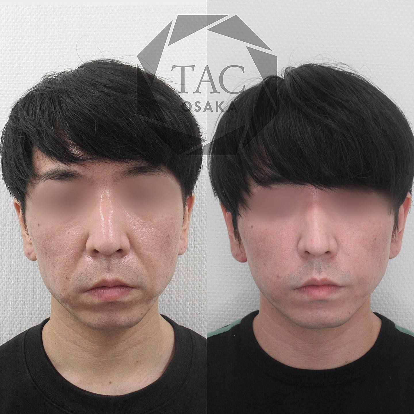 大阪の男性美容整形 メンズtaクリニックがモテる男をトータルプロデュース イケメン二重 美肌 ダイエット 鼻整形の名医 美容外科