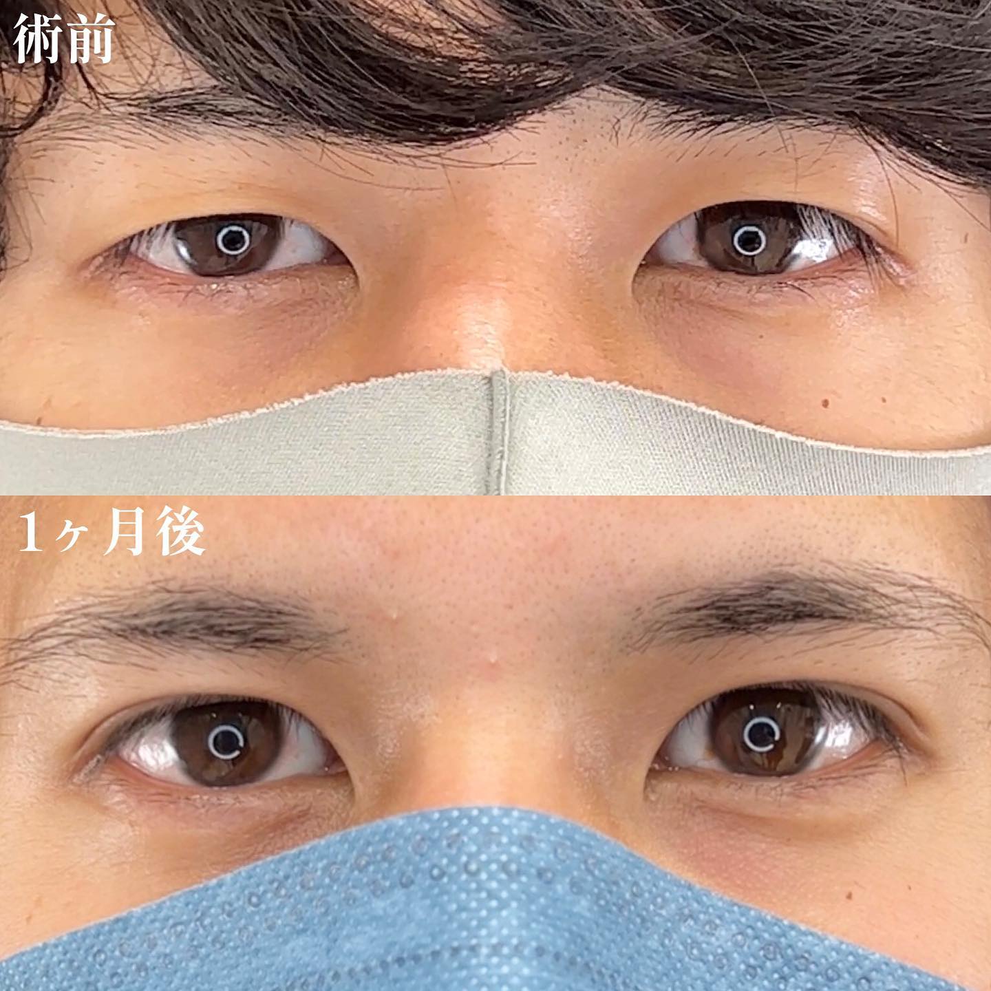 男性に多い美容外科施術 2 （画像あり） | 横浜で働く美容外科院長の美容整形ここだけの話ブログ