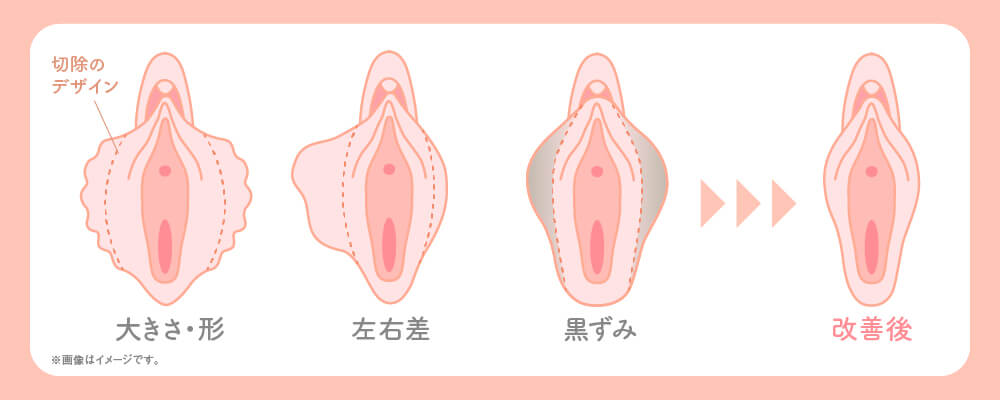 「女性器のビラビラが大きい…」改善するTAC式小陰唇縮小術（ヴィーナスシルエット）
