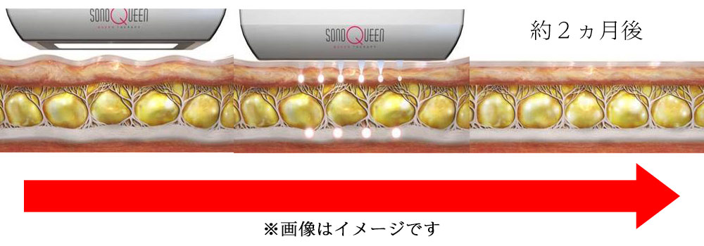 sonoQueen（ソノクイーン）は、HIFU（高密度焦点式超音波）のエネルギーで切らずに顔のリフトアップ・シワ改善ができる治療機器です
