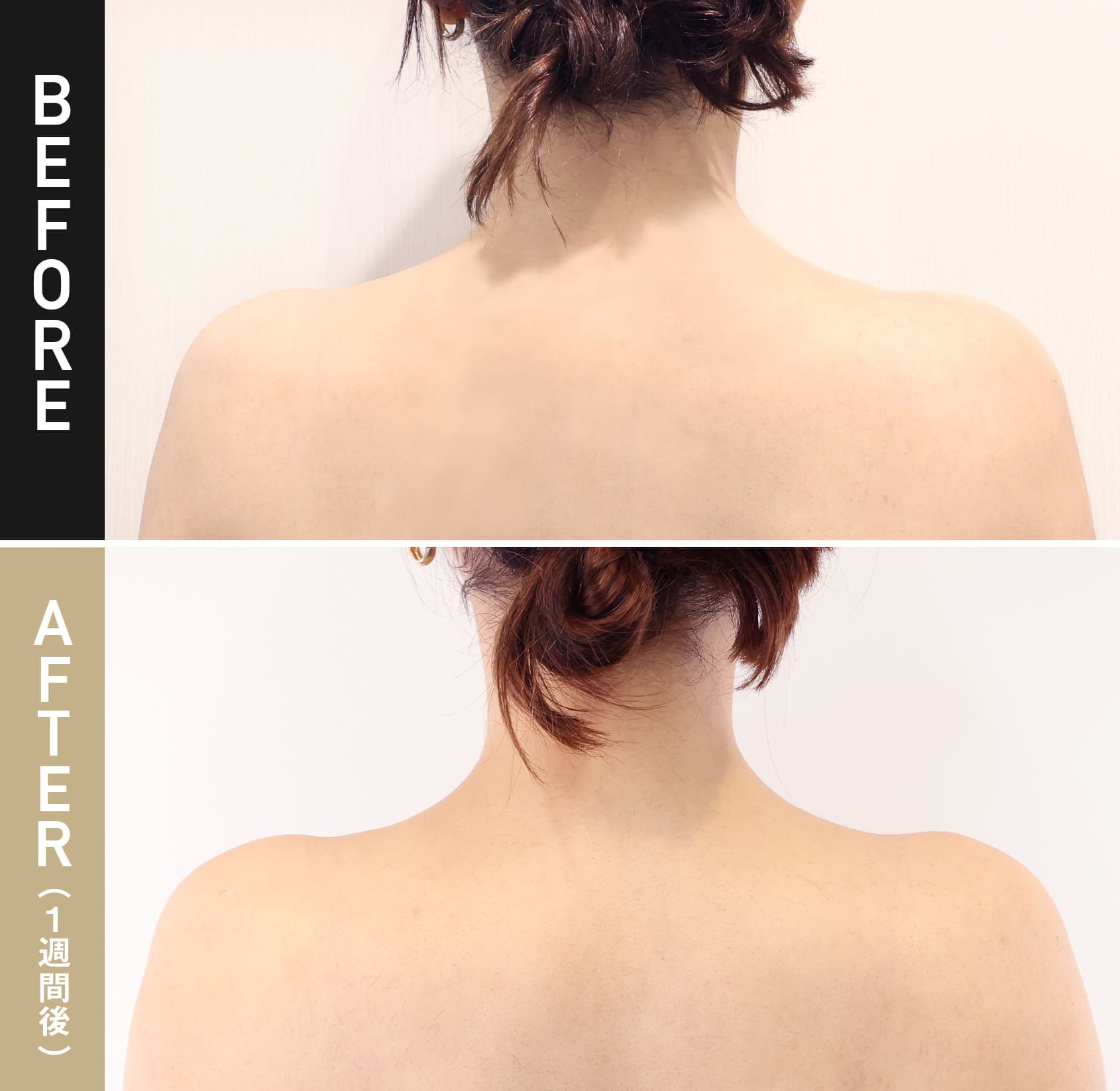 肩ボトックス注射|症例写真（術後1週間）|30代女性