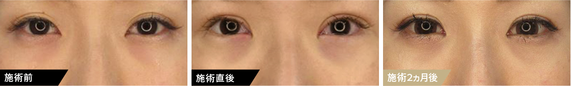 当クリニックの下眼瞼脱脂術は抜糸がないため、ダウンタイムも少なく、日常生活に戻りやすい