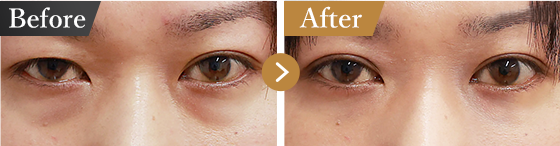 下眼瞼脱脂術（目の下のたるみ取り・目の下の脂肪ふくらみ取り）の症例写真