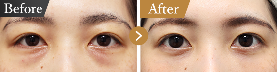 下眼瞼脱脂術（目の下のたるみ取り・目の下の脂肪ふくらみ取り）の症例写真