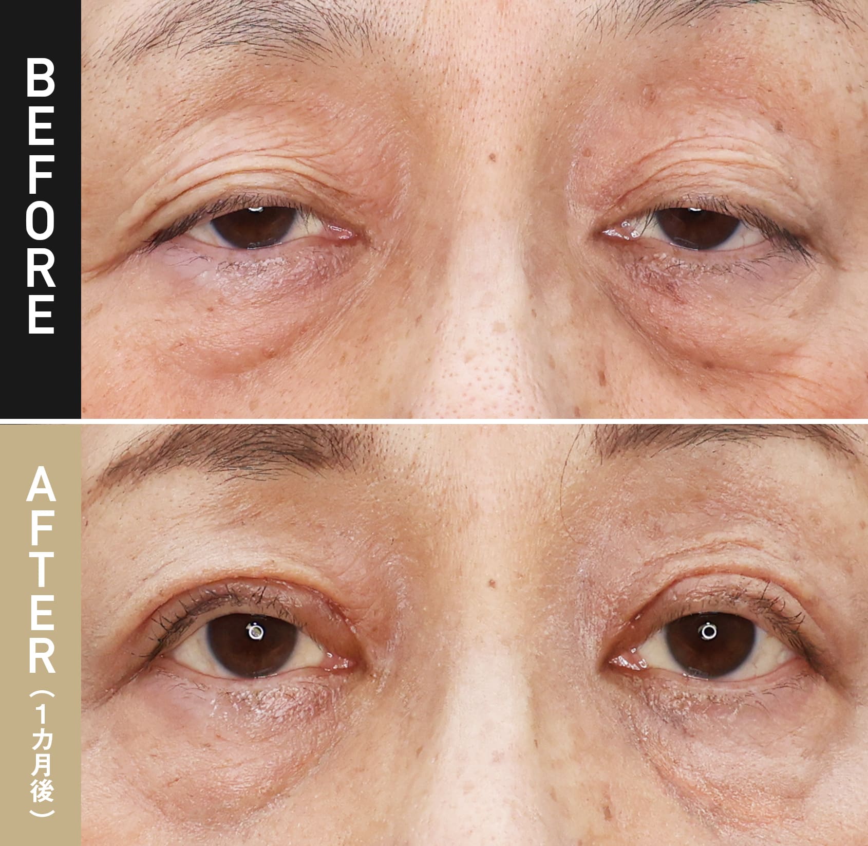 埋没眼瞼下垂（目つき矯正） |症例写真（術後3週間）|50代女性